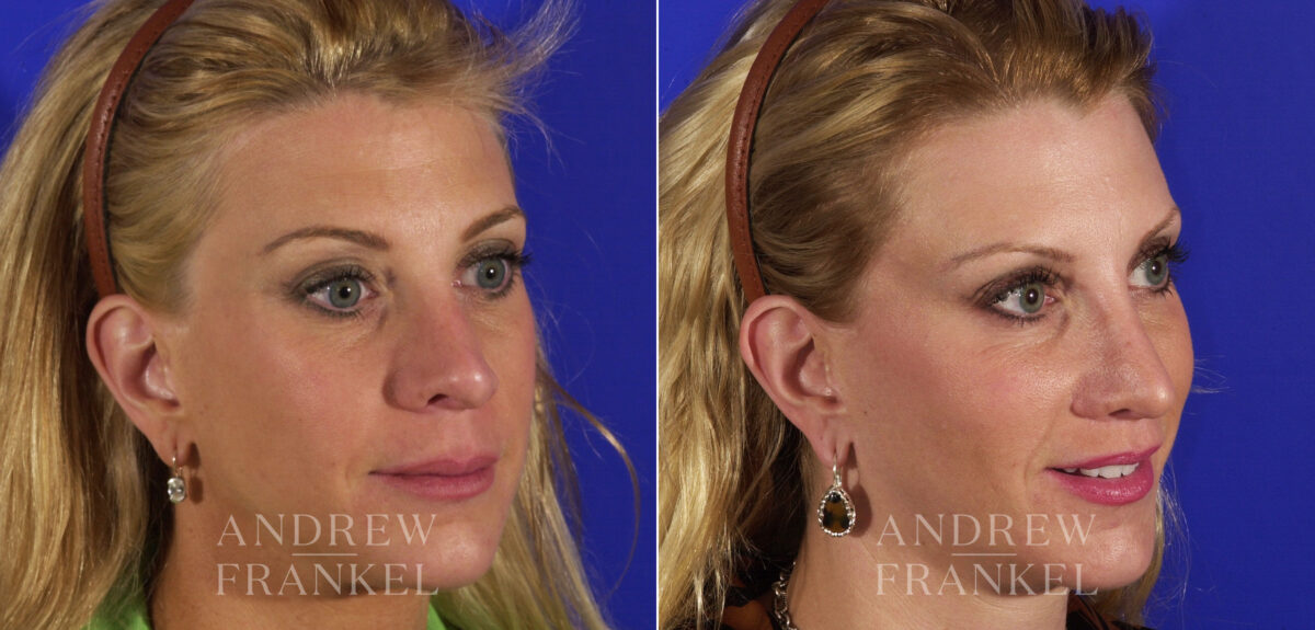 Lip Lift before and after photos in Beverly Hills, CA, Patient 4506