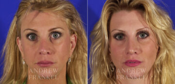 Lip Lift before and after photos in Beverly Hills, CA, Patient 4506