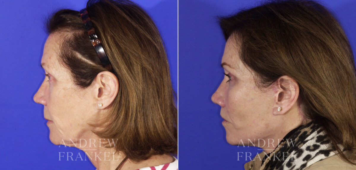 Facial Rejuvenation before and after photos in Beverly Hills, CA, Patient 4677