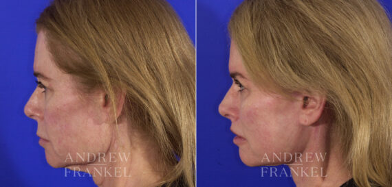 Facial Rejuvenation before and after photos in Beverly Hills, CA, Patient 4814