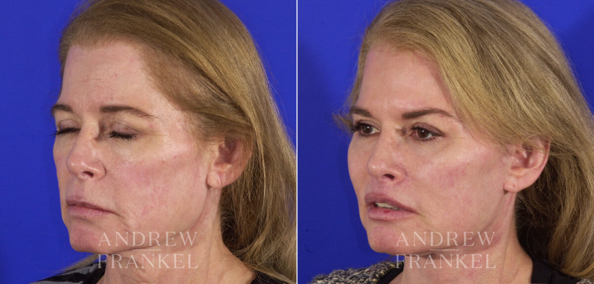 Facial Rejuvenation before and after photos in Beverly Hills, CA, Patient 4814