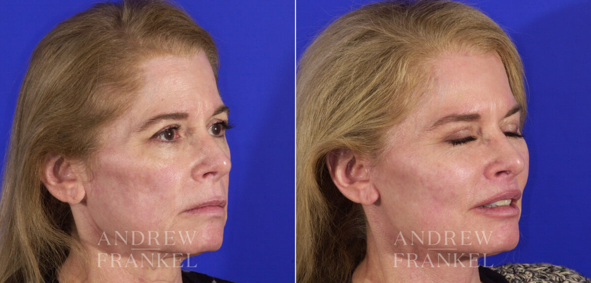 Facial Rejuvenation before and after photos in Beverly Hills, CA, Patient 4814