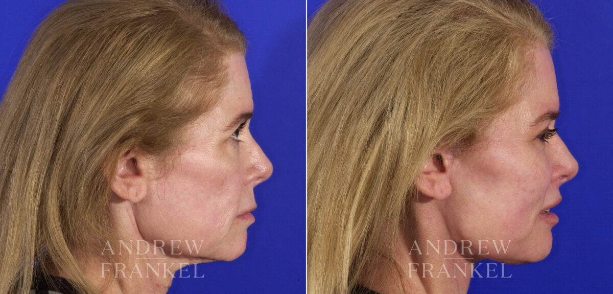 Facial Rejuvenation before and after photos in Beverly Hills, CA, Patient 4814