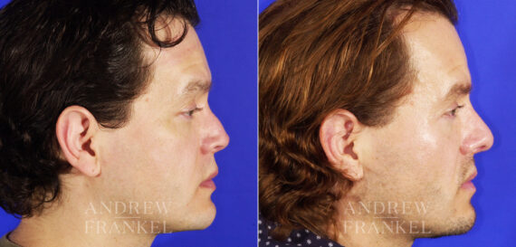 Revision Rhinoplasty before and after photos in Beverly Hills, CA, Patient 4917