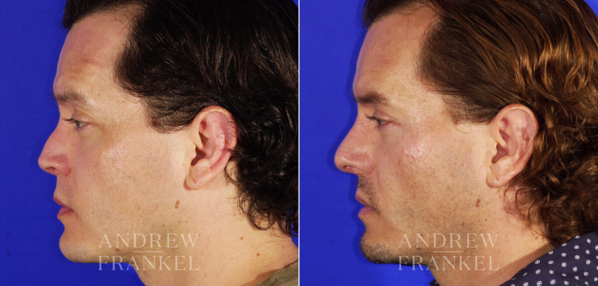 Revision Rhinoplasty before and after photos in Beverly Hills, CA, Patient 4917