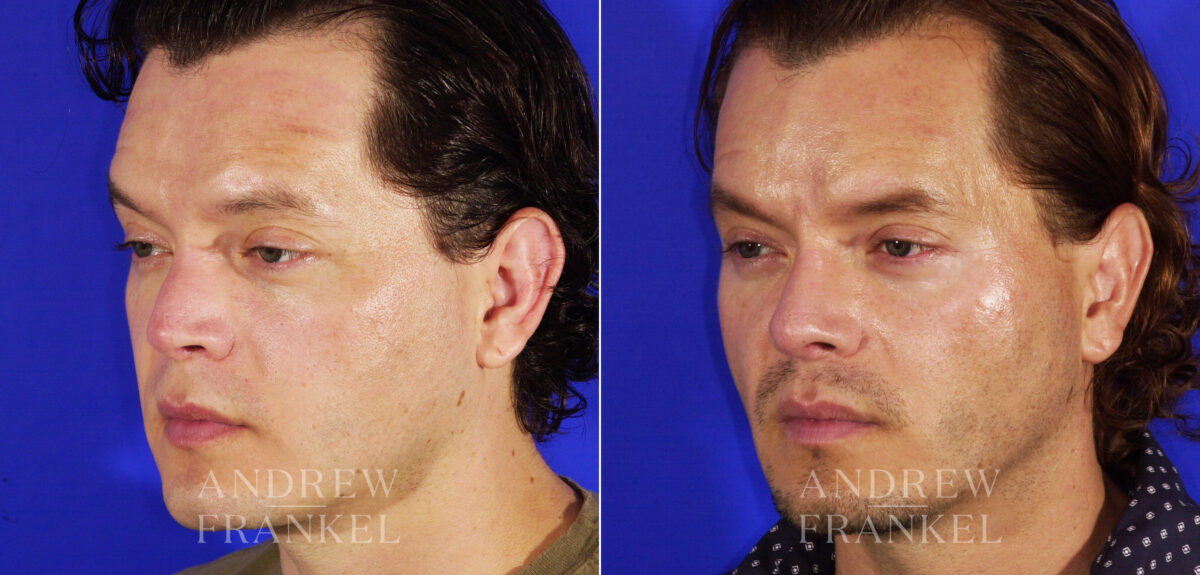Revision Rhinoplasty before and after photos in Beverly Hills, CA, Patient 4917