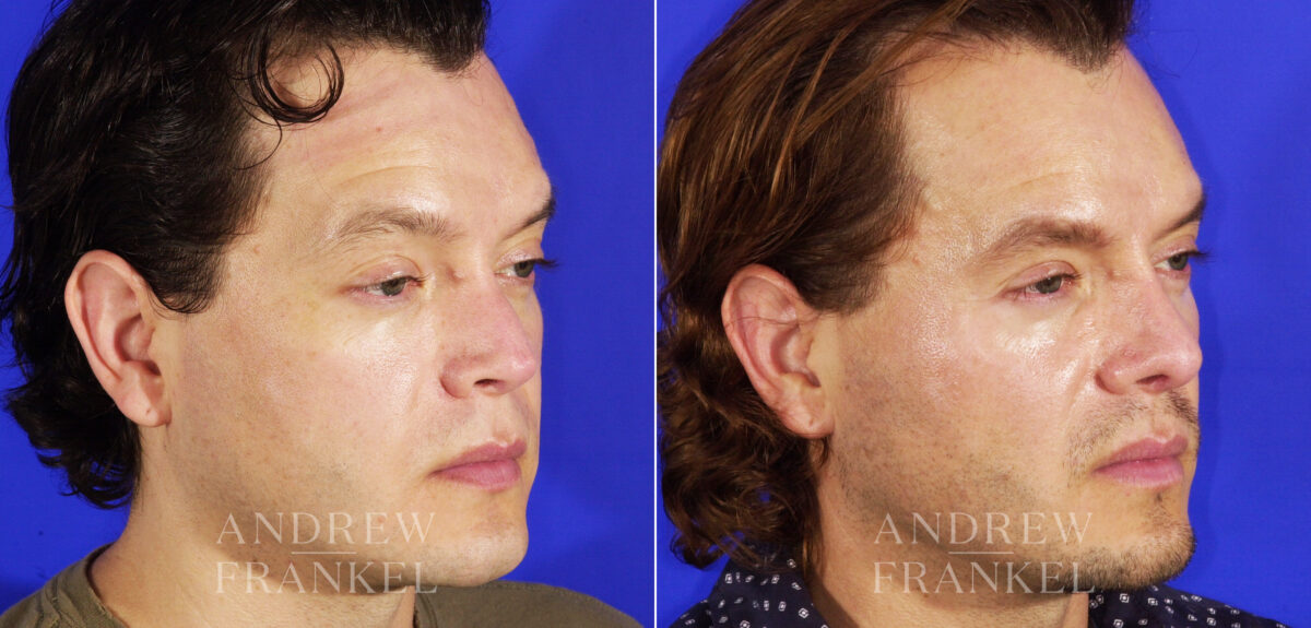 Revision Rhinoplasty before and after photos in Beverly Hills, CA, Patient 4917