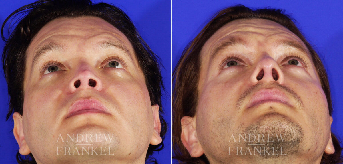 Revision Rhinoplasty before and after photos in Beverly Hills, CA, Patient 4917
