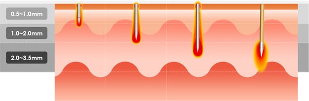 Laser Skin Rejuvenation in California