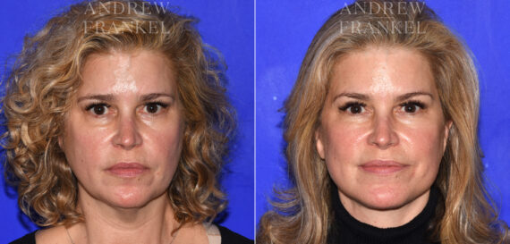 Facelift before and after photos in Beverly Hills, CA, Patient 18986