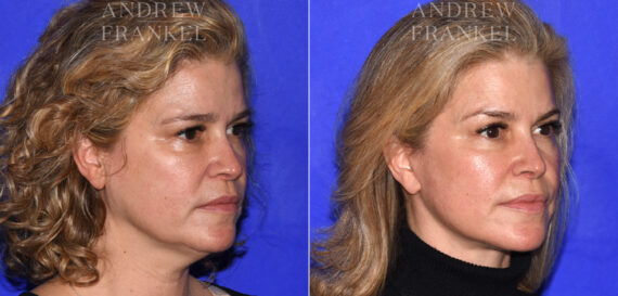 Facelift before and after photos in Beverly Hills, CA, Patient 18986