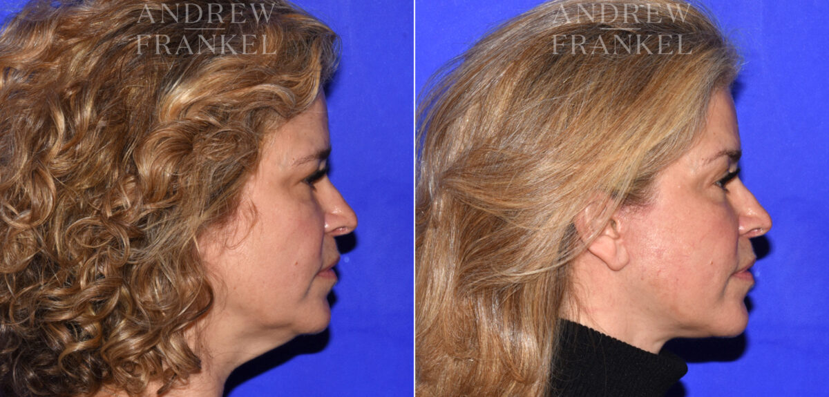 Facelift before and after photos in Beverly Hills, CA, Patient 18986