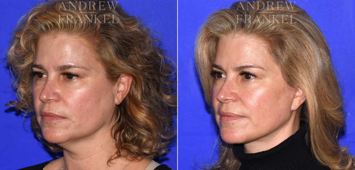 Facelift before and after photos in Beverly Hills, CA, Patient 18986
