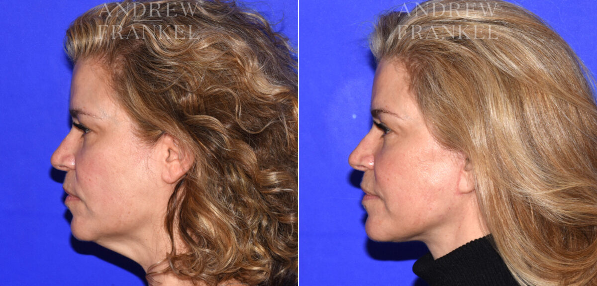 Facelift before and after photos in Beverly Hills, CA, Patient 18986