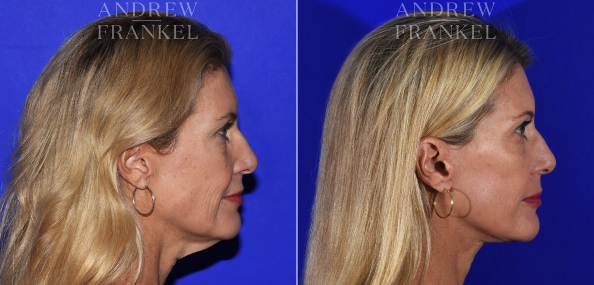 Facelift before and after photos in Beverly Hills, CA, Patient 19020
