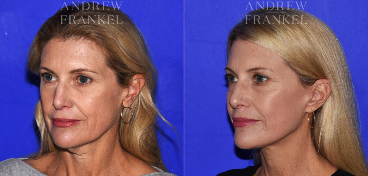 Facelift before and after photos in Beverly Hills, CA, Patient 19020