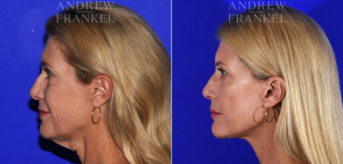 Facelift before and after photos in Beverly Hills, CA, Patient 19020