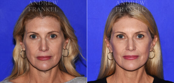 Facelift before and after photos in Beverly Hills, CA, Patient 19020