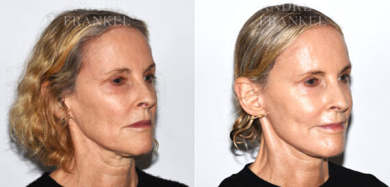 Facelift before and after photos in Beverly Hills, CA, Patient 19159