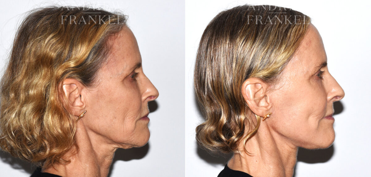 Facelift before and after photos in Beverly Hills, CA, Patient 19159
