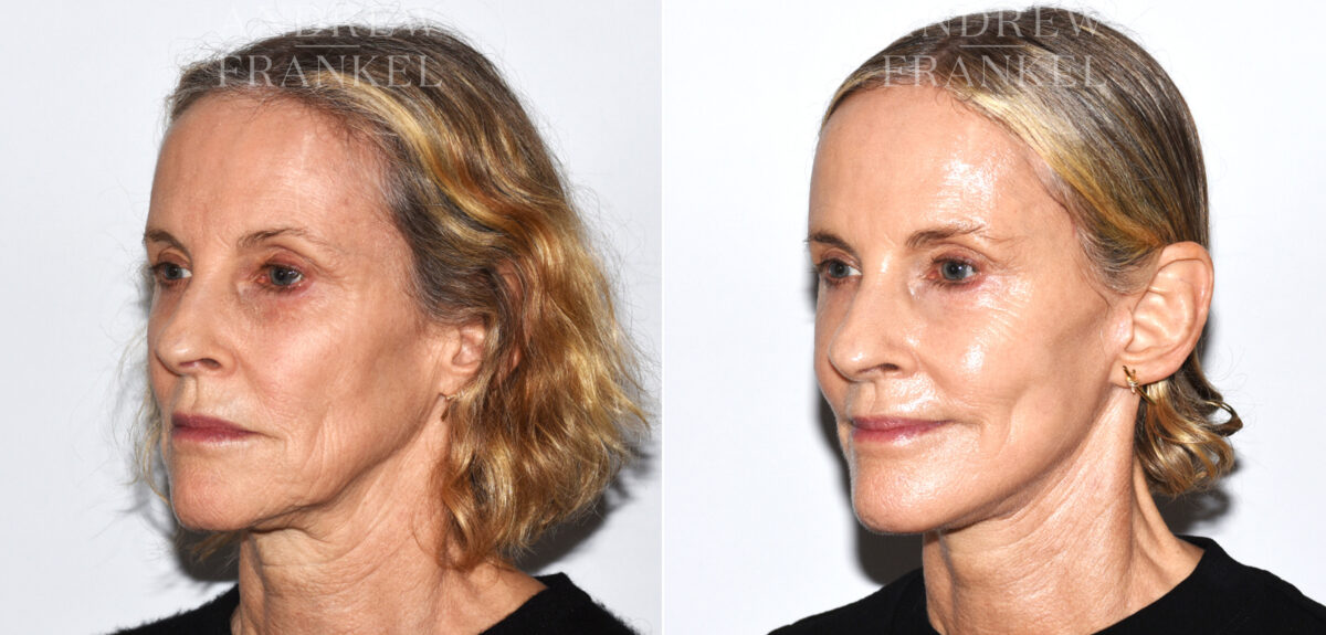 Facelift before and after photos in Beverly Hills, CA, Patient 19159