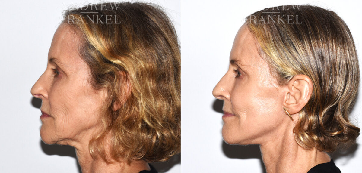 Facelift before and after photos in Beverly Hills, CA, Patient 19159