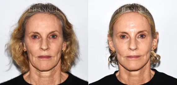 Facelift before and after photos in Beverly Hills, CA, Patient 19159