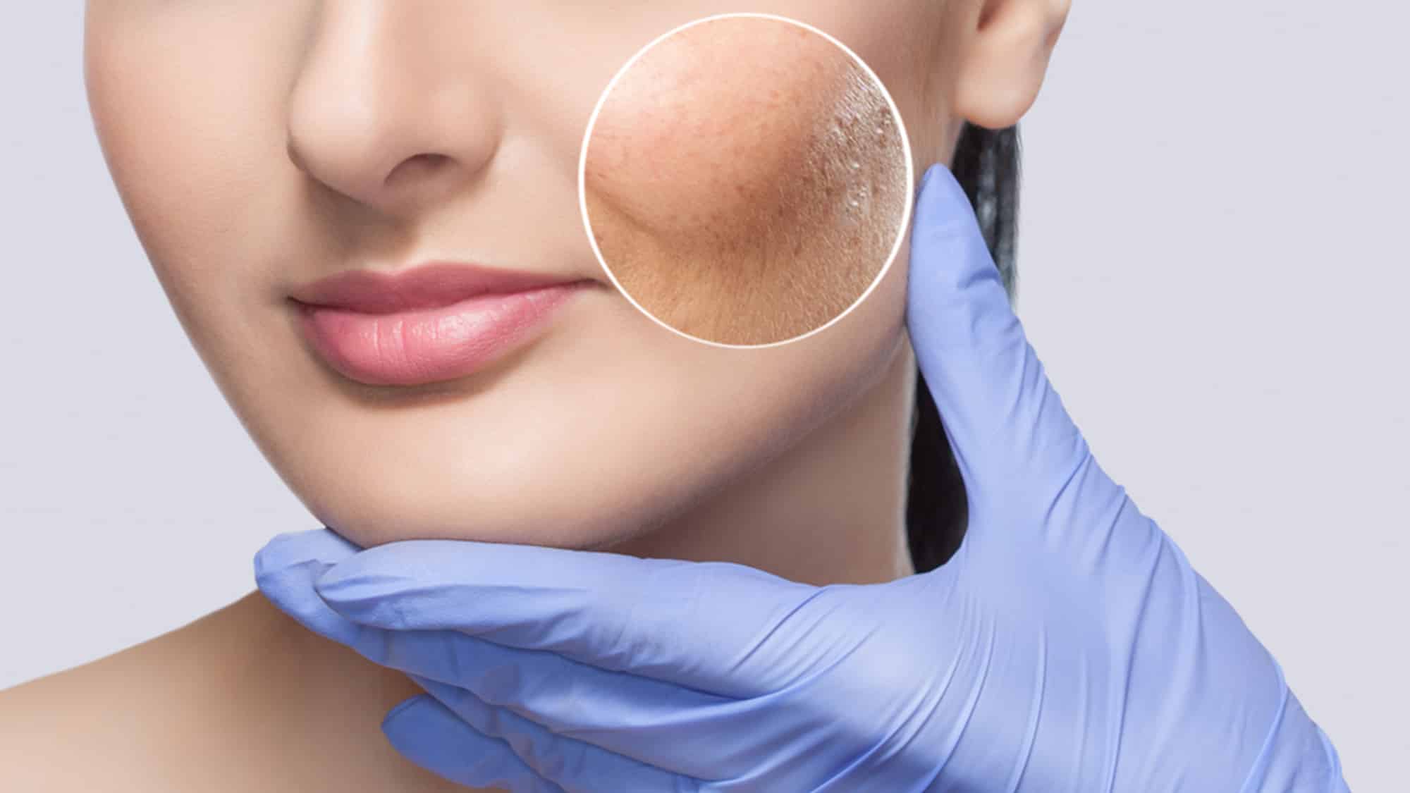 Laser skin rejuvenation costs vary depending on the type of treatment, the size of treated area and the number of treatments needed