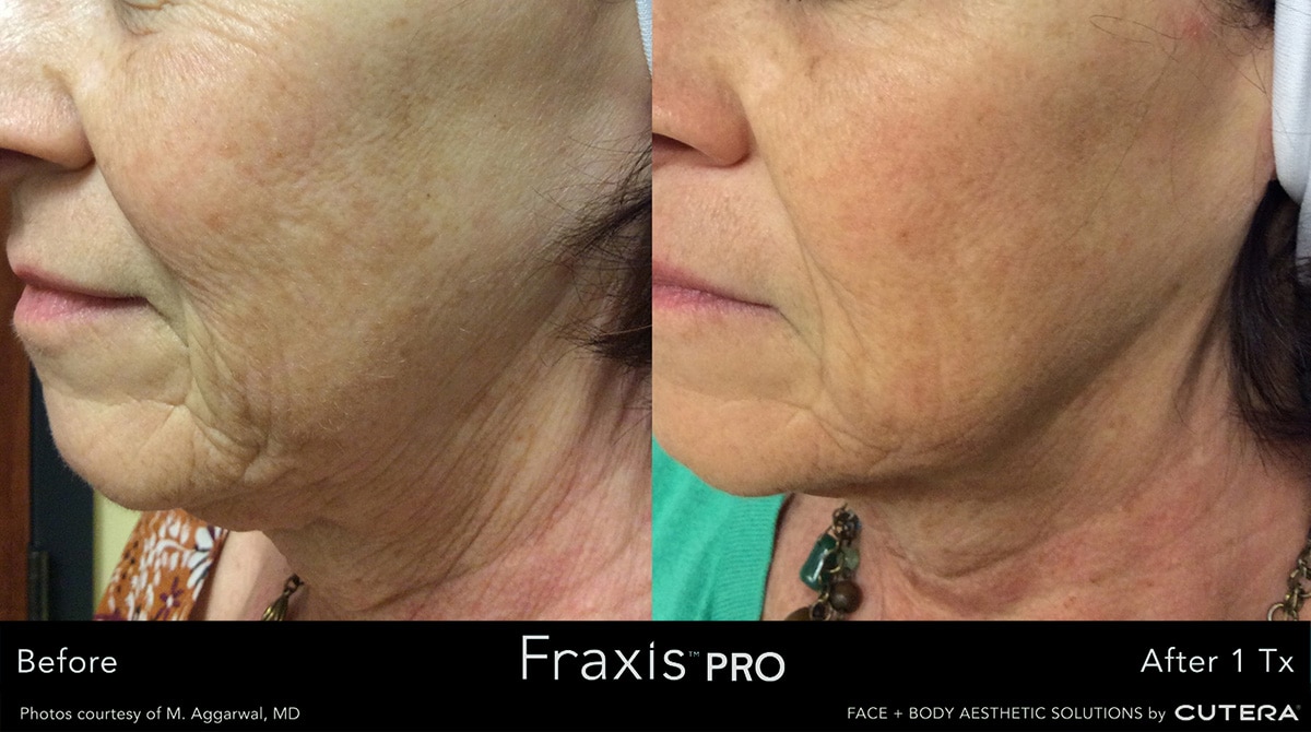 Fraxis PRO Before and After