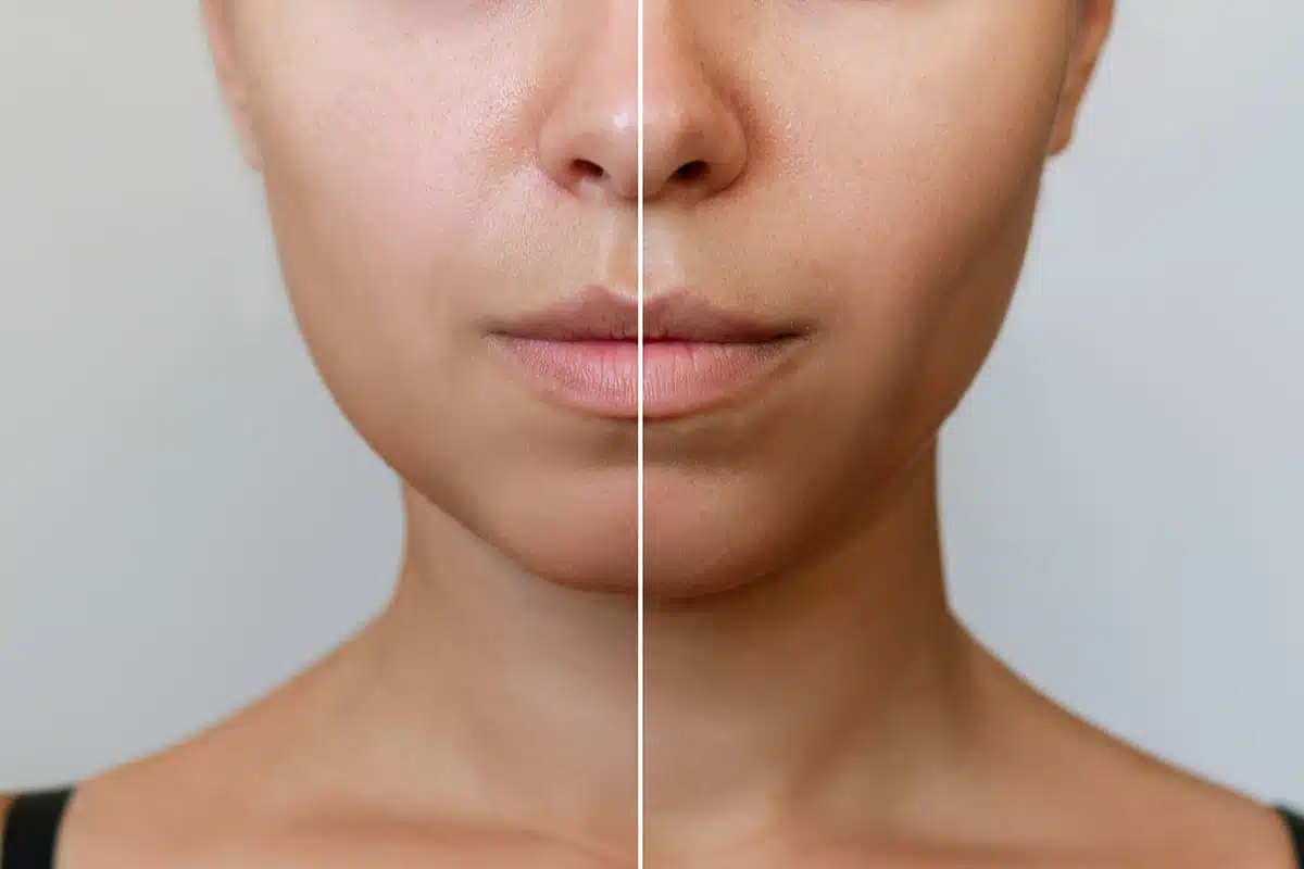 Fronta view before and after a buccal fat pad removal surgery, on the left, the patient has excess cheek fat, on the right, she has a more sculpted appearance.