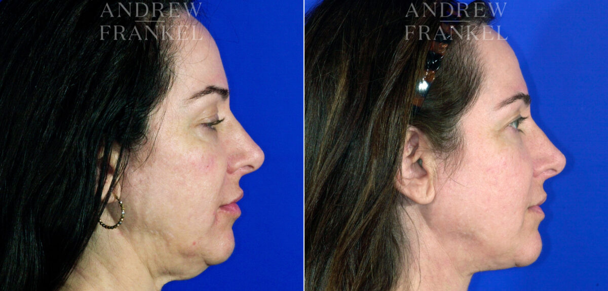 Neck Lift before and after photos in Beverly Hills, CA, Patient 3734