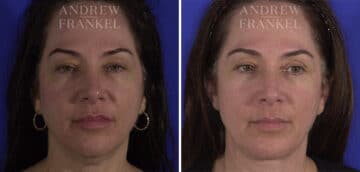 Neck Lift before and after photos in Beverly Hills, CA, Patient 3734