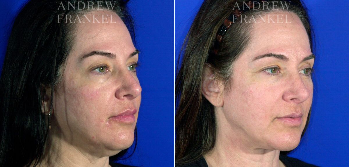 Neck Lift before and after photos in Beverly Hills, CA, Patient 3734