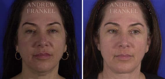 Neck Lift before and after photos in Beverly Hills, CA, Patient 3734