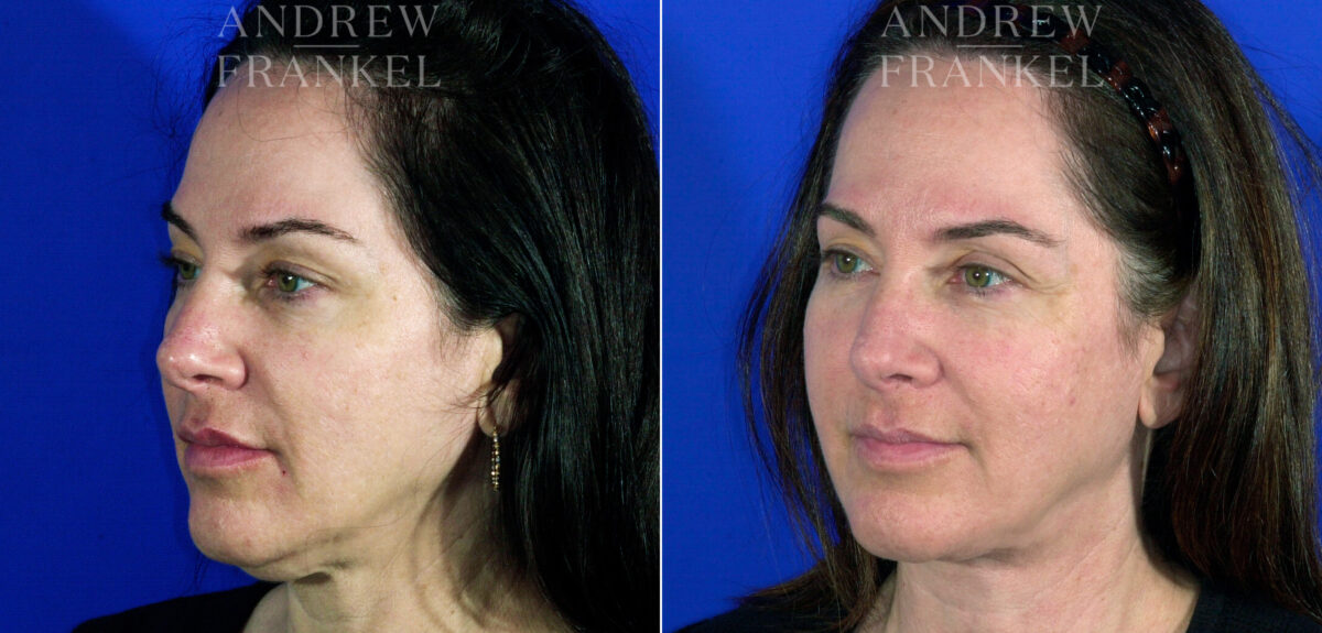 Neck Lift before and after photos in Beverly Hills, CA, Patient 3734