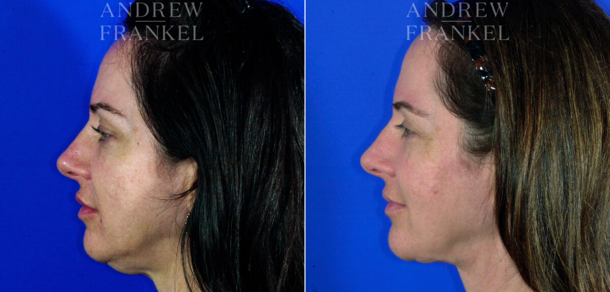 Neck Lift before and after photos in Beverly Hills, CA, Patient 3734