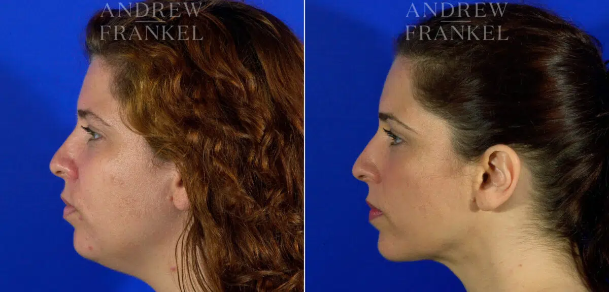 Jawline Contouring before and after photos in Beverly Hills, CA, Patient 3794