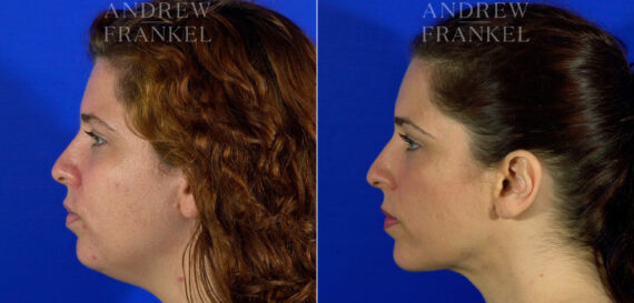 Jawline Contouring before and after photos in Beverly Hills, CA, Patient 3794