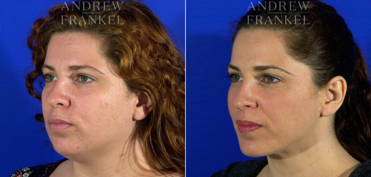 Jawline Contouring before and after photos in Beverly Hills, CA, Patient 3794