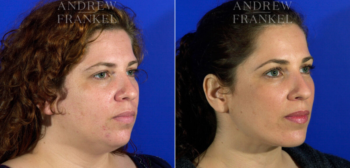 Jawline Contouring before and after photos in Beverly Hills, CA, Patient 3794