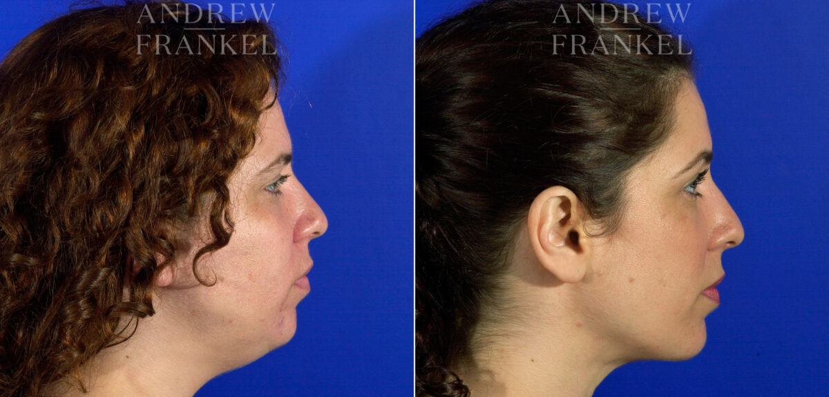 Jawline Contouring before and after photos in Beverly Hills, CA, Patient 3794