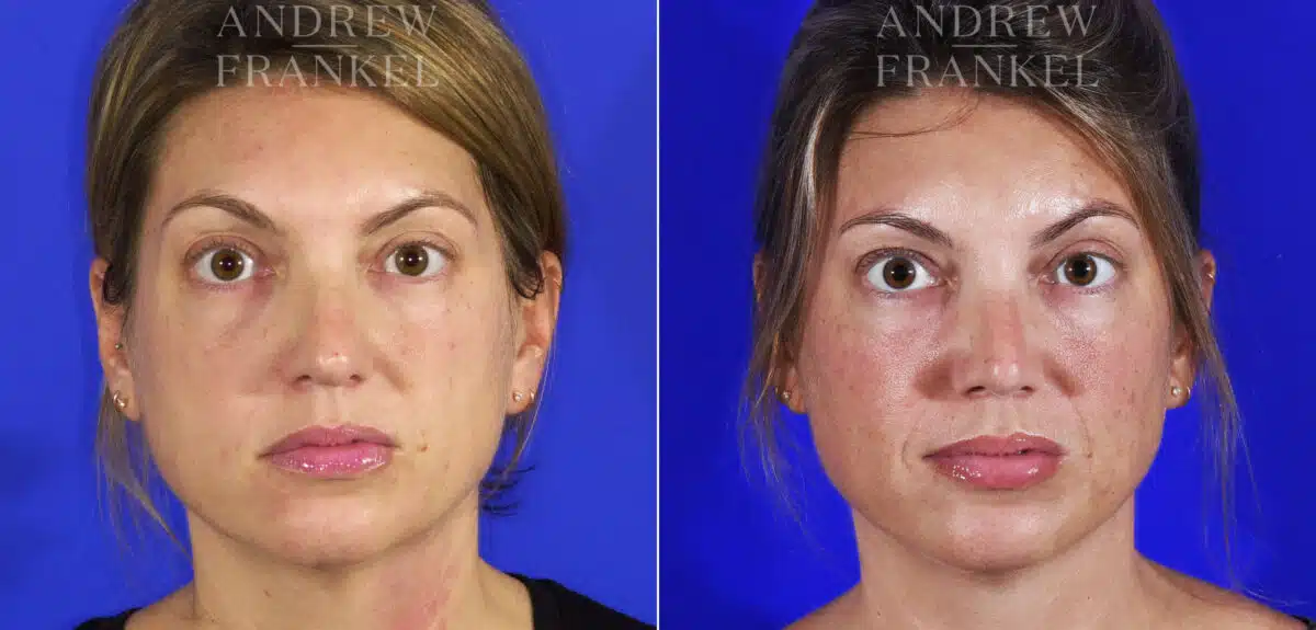 Revision Rhinoplasty before and after photos in Beverly Hills, CA, Patient 6834