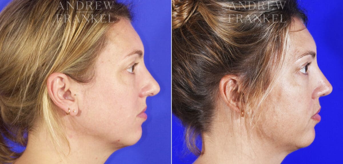 Revision Rhinoplasty before and after photos in Beverly Hills, CA, Patient 6834