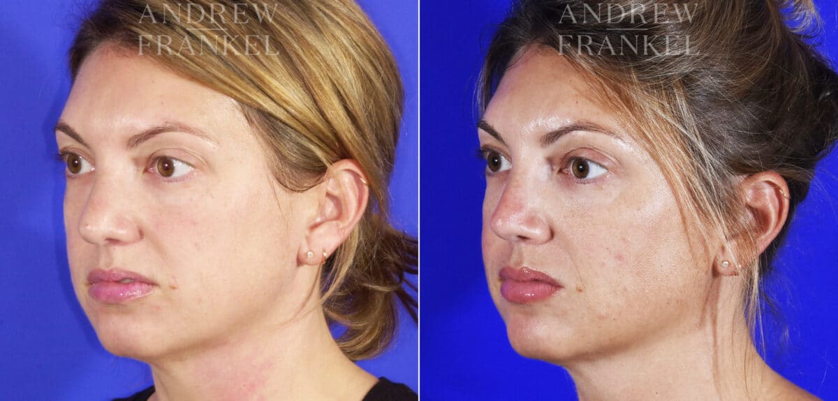 Revision Rhinoplasty before and after photos in Beverly Hills, CA, Patient 6834