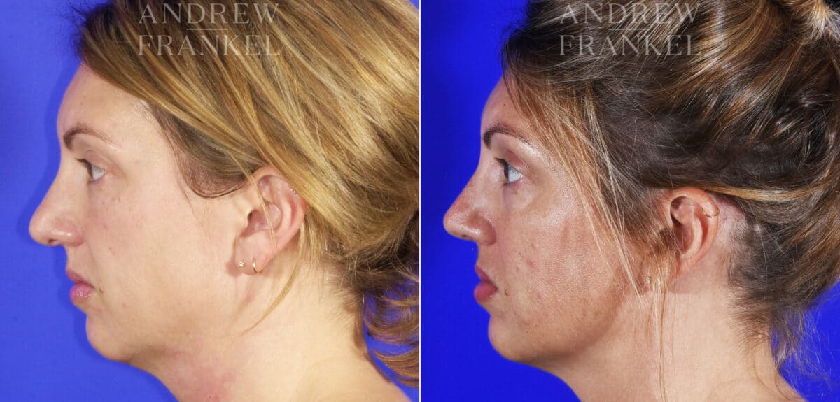 Revision Rhinoplasty before and after photos in Beverly Hills, CA, Patient 6834