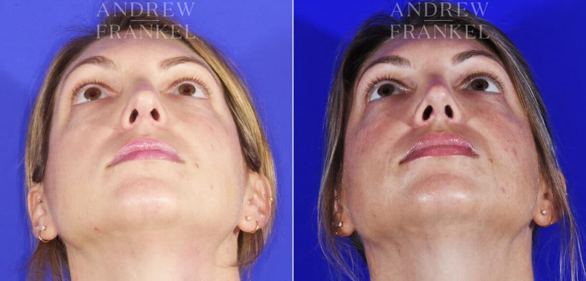 Revision Rhinoplasty before and after photos in Beverly Hills, CA, Patient 6834