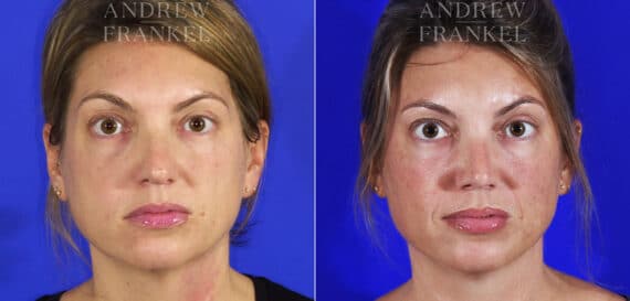 Revision Rhinoplasty before and after photos in Beverly Hills, CA, Patient 6834