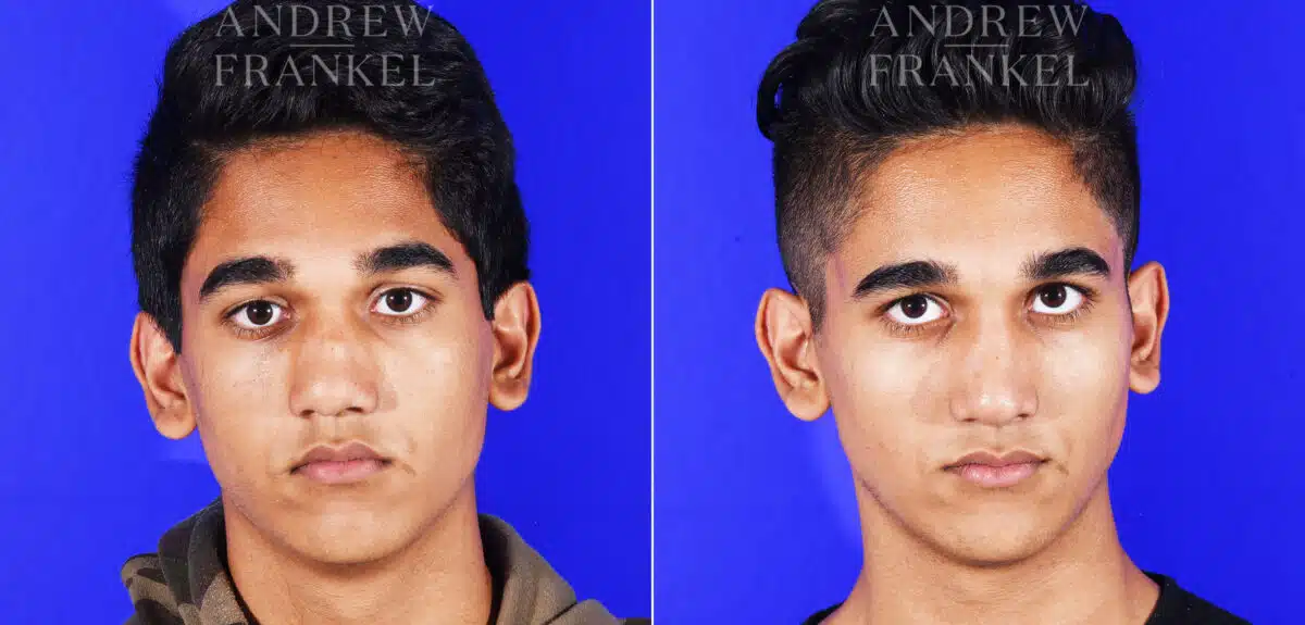 Revision Rhinoplasty before and after photos in Beverly Hills, CA, Patient 12553