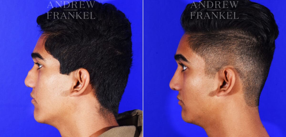 Revision Rhinoplasty before and after photos in Beverly Hills, CA, Patient 12553
