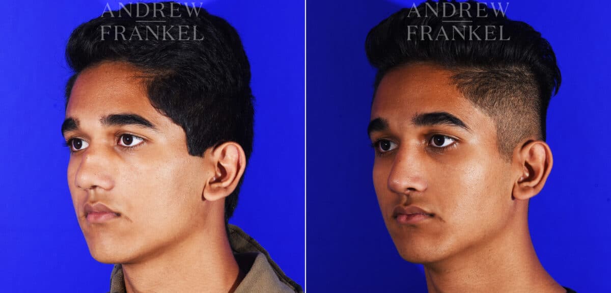 Revision Rhinoplasty before and after photos in Beverly Hills, CA, Patient 12553